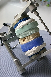 Das Gipsmodell mit dem neuen Zahn wird im Artikulator fixiert. Dort werden Form und Funktion des Zahnes geprüft. 